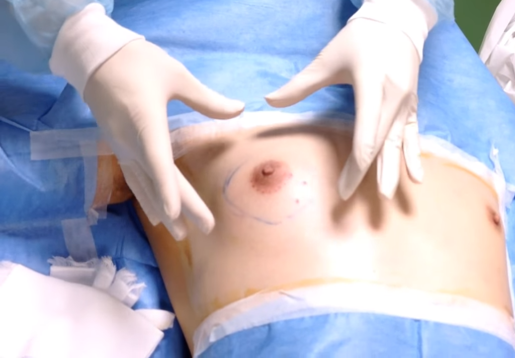 胸の左右差を訴える真性女性化乳房ゲスト（術前）