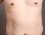 男の脂肪吸引「4Dスカルプト」で、ビール腹にサヨナラ!