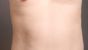 男の脂肪吸引「4Dスカルプト」で、ビール腹にサヨナラ!