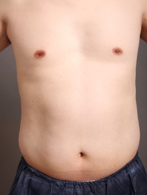 男の脂肪吸引「4Dスカルプト」で、ビール腹にサヨナラ!