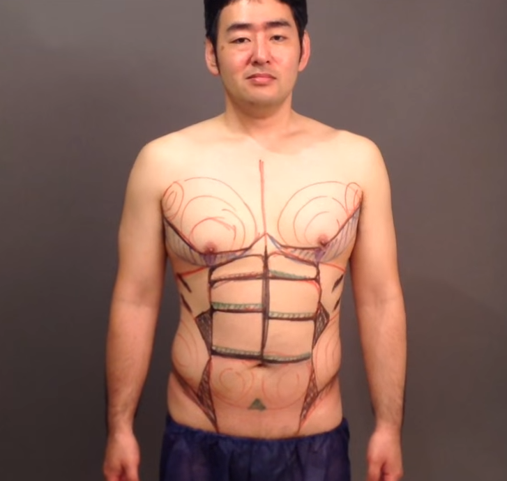 脂肪吸引の術前マーキング（男性／お腹）
