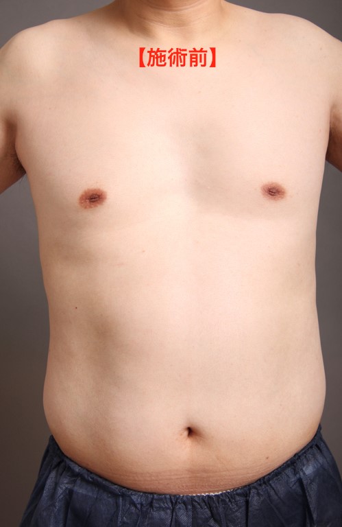 脂肪吸引希望の男性ゲスト