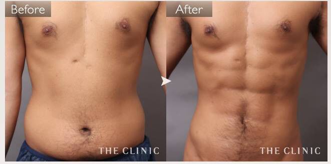 男性の脂肪吸引で得られた劇的な変化