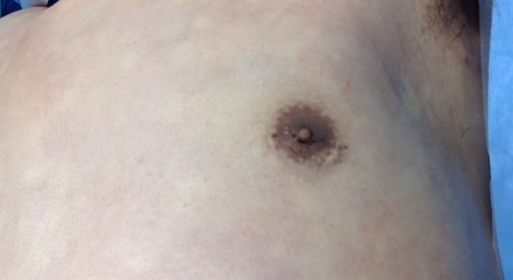 女性化乳房の手術(2回目)の傷跡