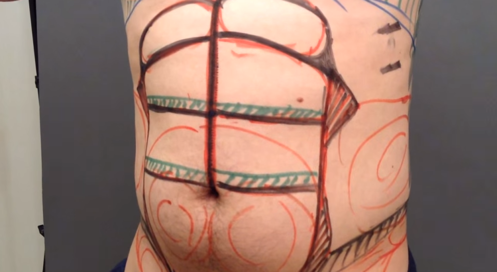 男性の脂肪吸引の術前に行ったマーキング