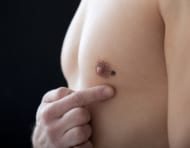 女性化乳房（真性）の乳腺切除術。結果は? 傷跡は?