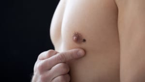 女性化乳房（真性）の乳腺切除術。結果は? 傷跡は?