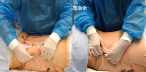 脂肪吸引前後（男性／背中）