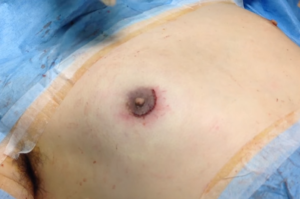 真性女性化乳房の傷跡（術後）