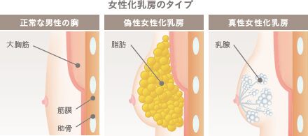 真性女性化乳房と偽性女性化乳房の違い