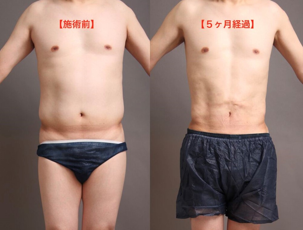男性の脂肪吸引の術前後比較(正面)