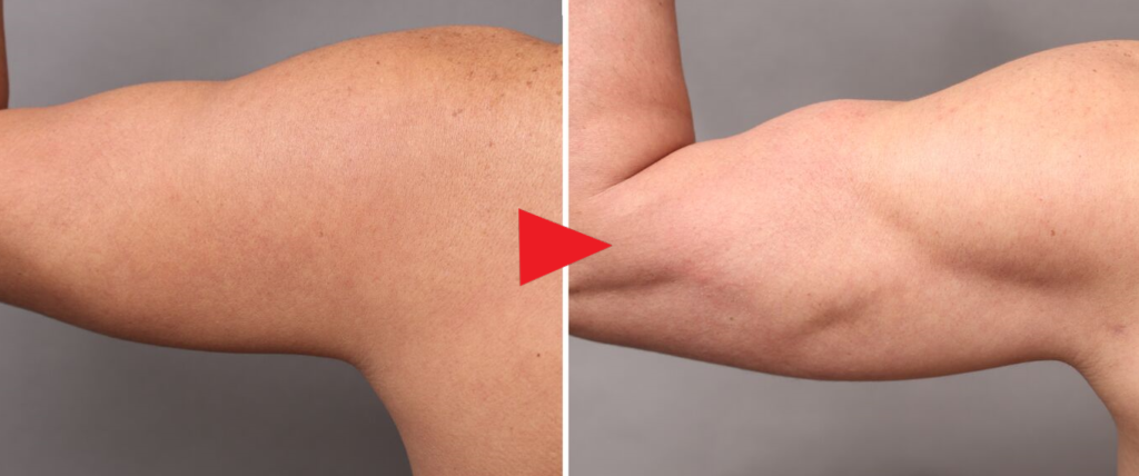 男性専用脂肪吸引「ベイザー4Dスカルプト」の症例まとめ