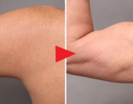 男性専用脂肪吸引「ベイザー4Dスカルプト」の症例まとめ