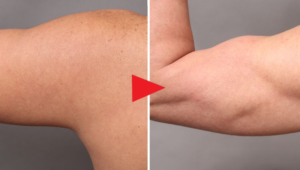 男性専用脂肪吸引「ベイザー4Dスカルプト」の症例まとめ