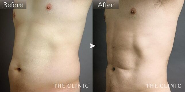 4Dスカルプト脂肪吸引④:緊張感のあるお腹に仕上がった40代の男性