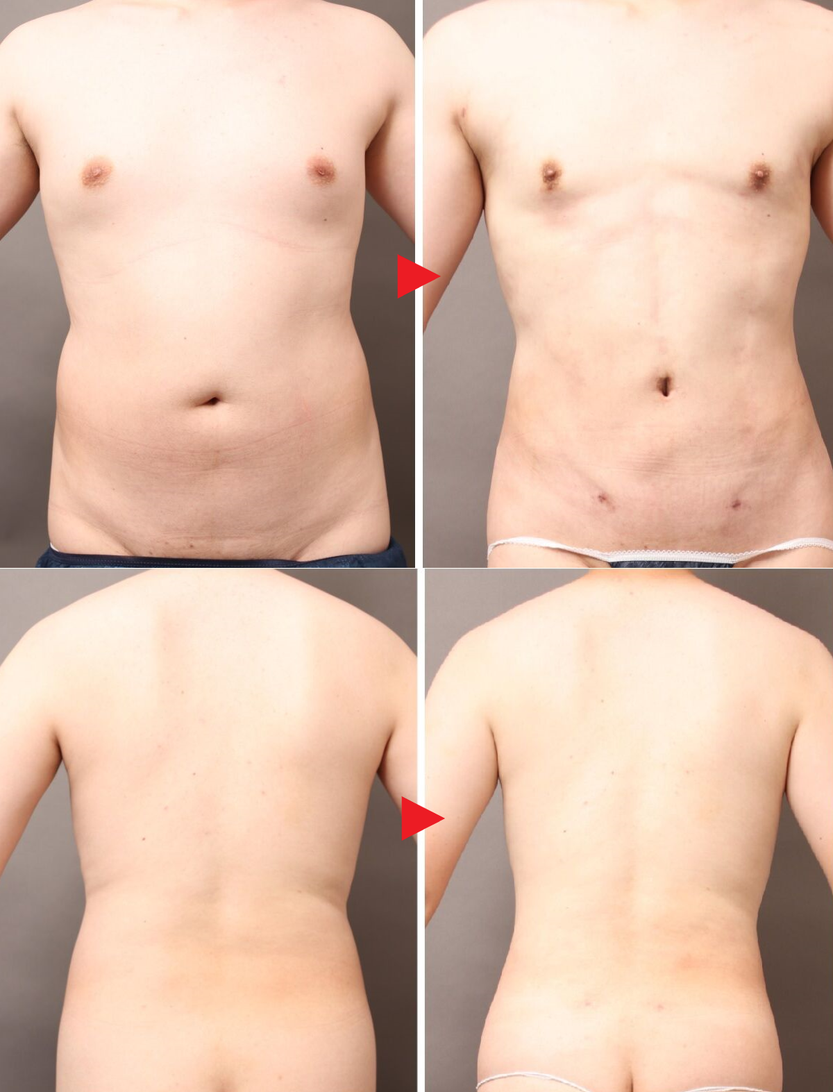 4Dスカルプト脂肪吸引⑤:シックスパックにしたくなかった男性