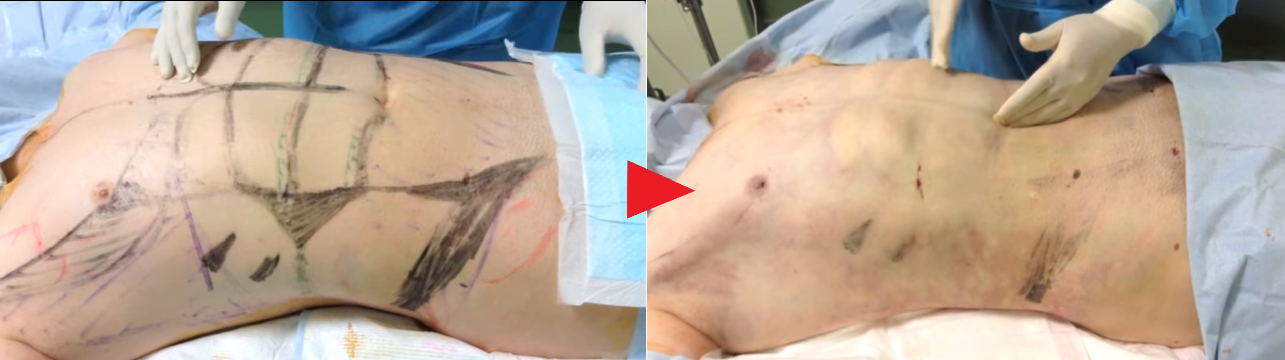 脂肪吸引直後(正面/男性)