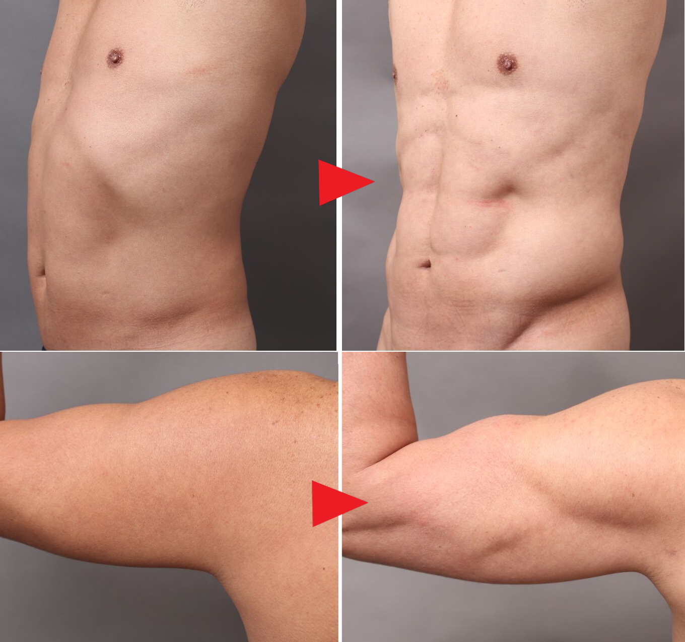 脂肪吸引の術前後比較(50代男性)