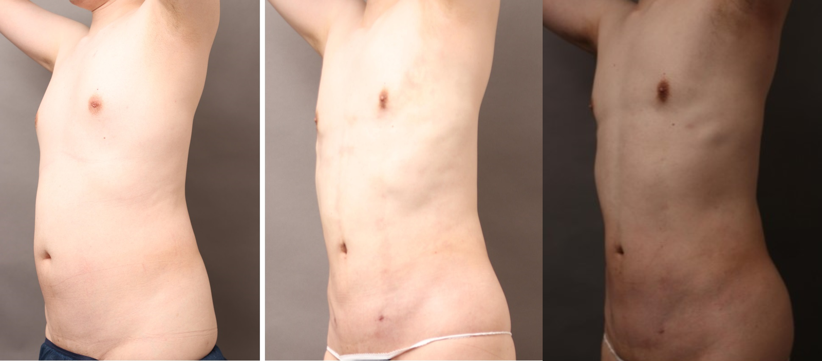 脂肪吸引の術前後比較(男性/横)