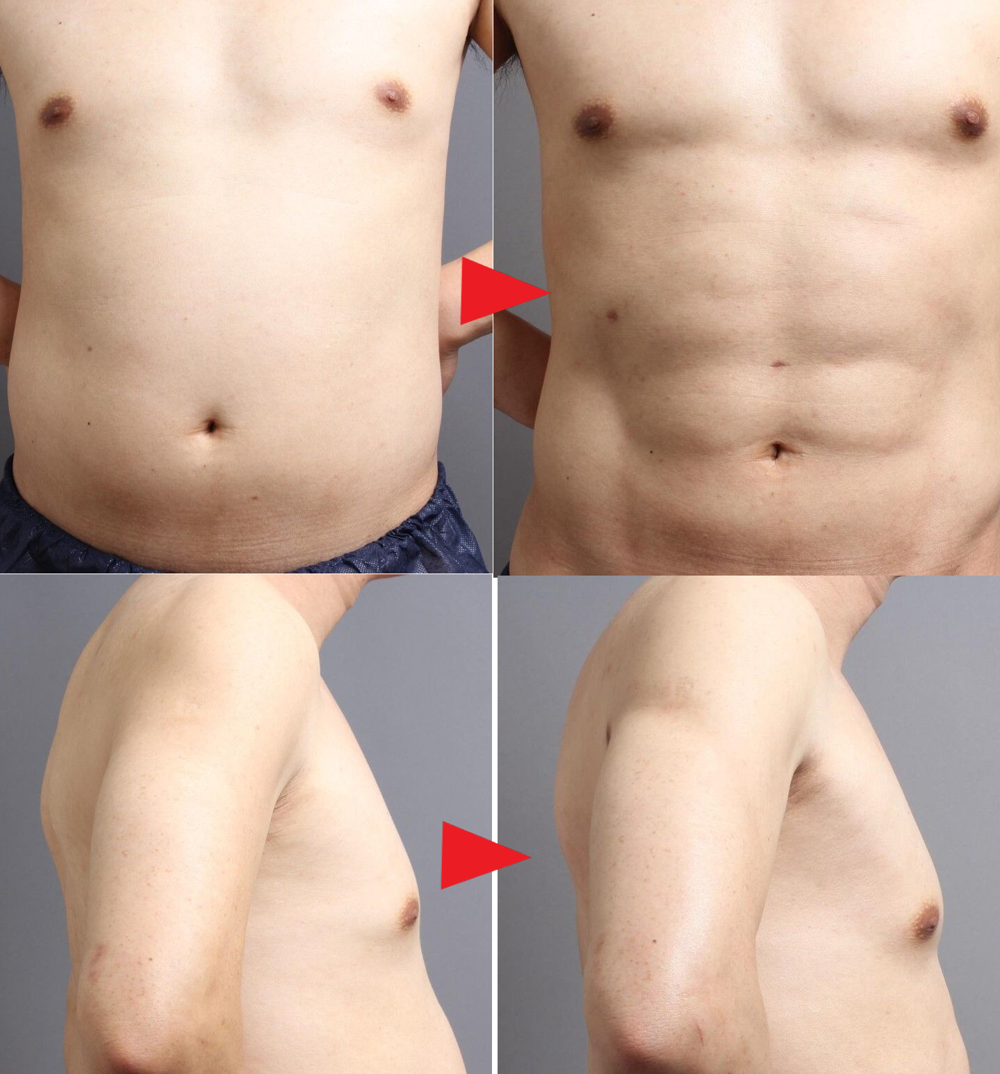 4Dスカルプト脂肪吸引②:上半身をトータルでデザインした男性