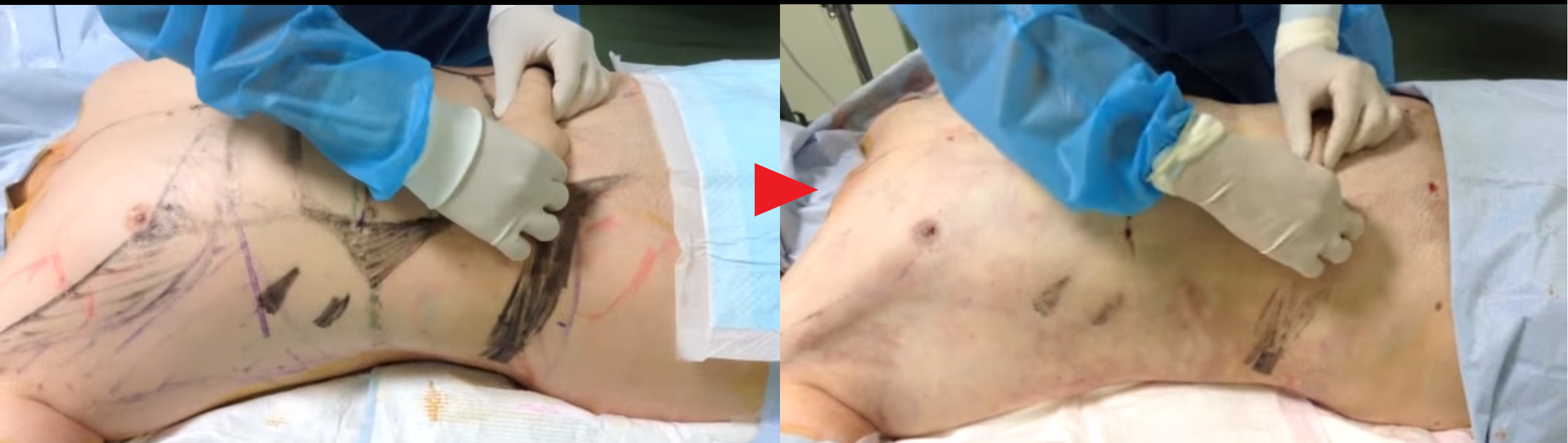 脂肪吸引前後の比較(男性)