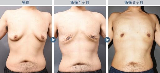 真性女性化乳房の治療前後比較