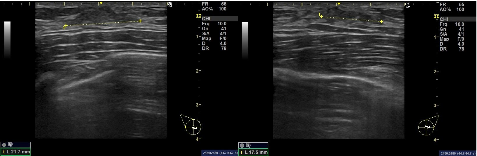 女性化乳房の乳腺(エコー画像)