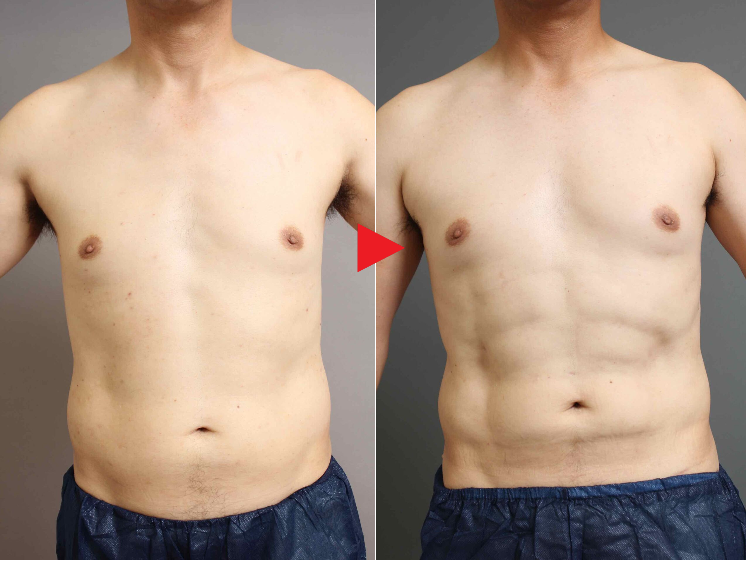 4Dスカルプト脂肪吸引③:お腹の革命的変化を実現した男性