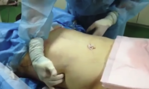 男性の脂肪吸引術前（腹部）