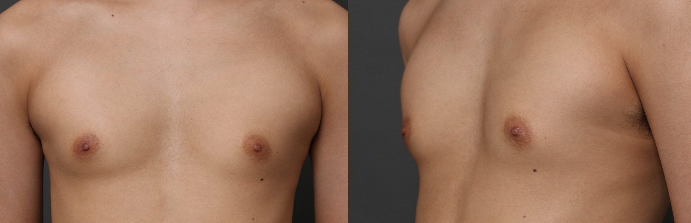 女性化乳房(痩せている症例)