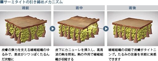 皮膚の引き締め施術：サーミタイト