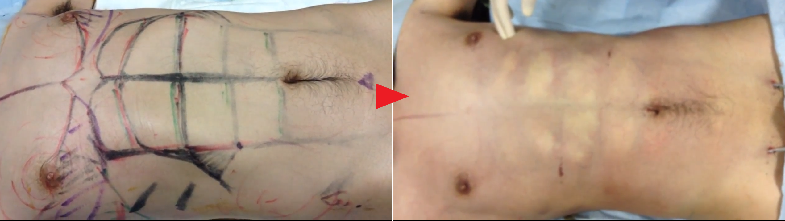 術前と脂肪吸引直後の比較（20代男性）