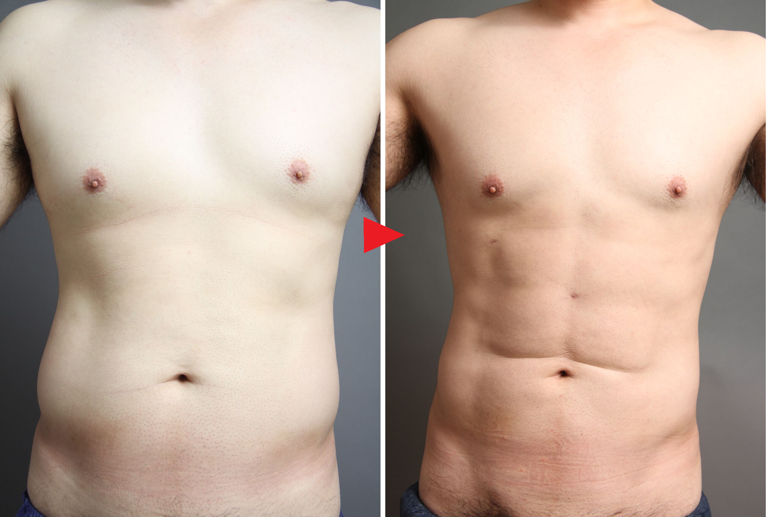 4Dスカルプト脂肪吸引⑥:本来の筋肉の陰影が見事に描出された男性