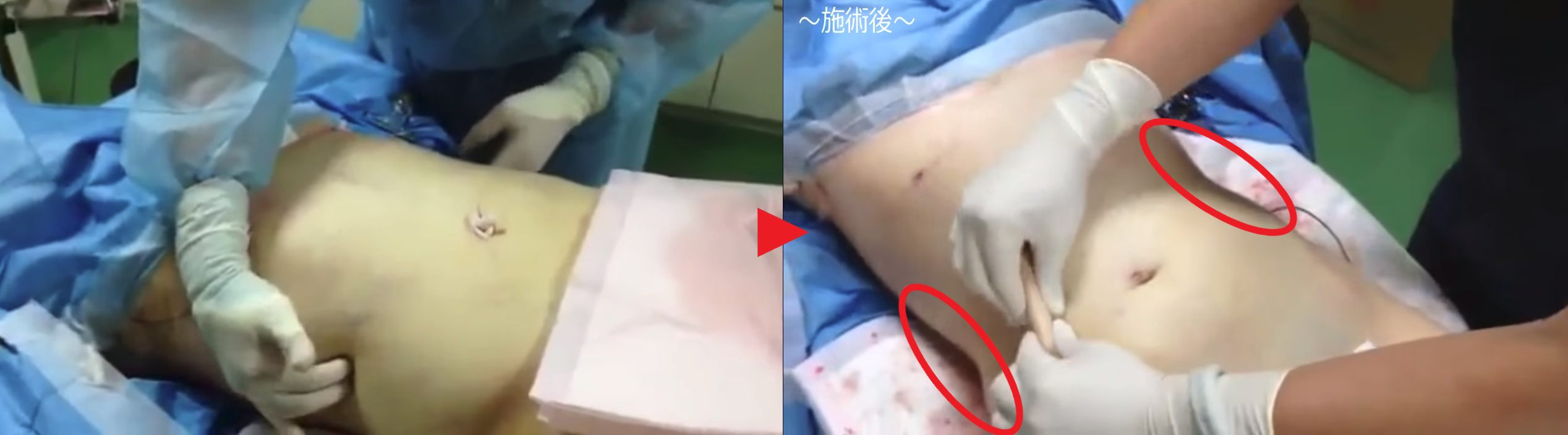 男性のお腹の脂肪吸引（手術前後）