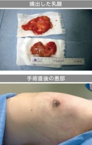 真性女性化乳房から摘出した乳腺と、術後の患部