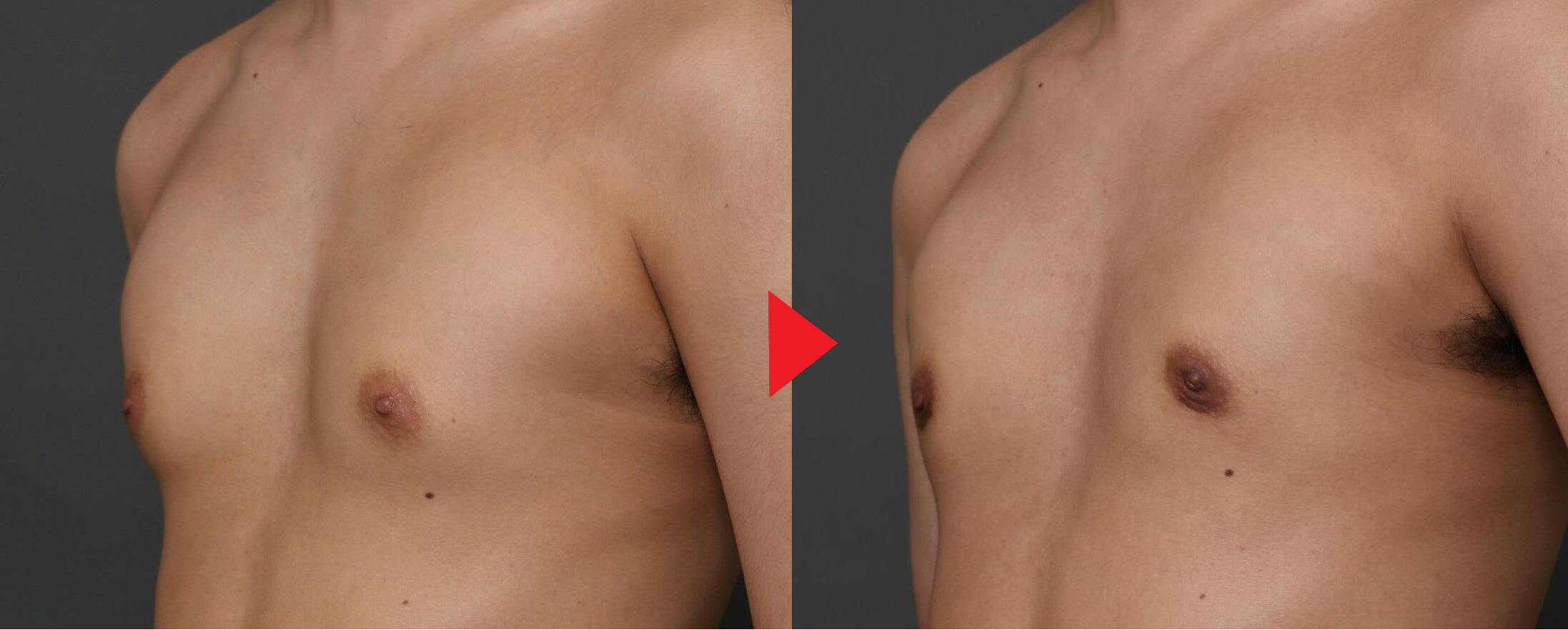 女性化乳房の手術前後の比較