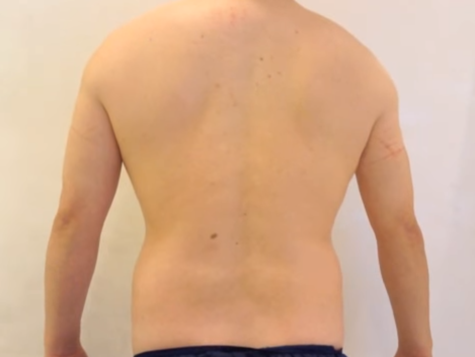 脂肪吸引術前(背面)