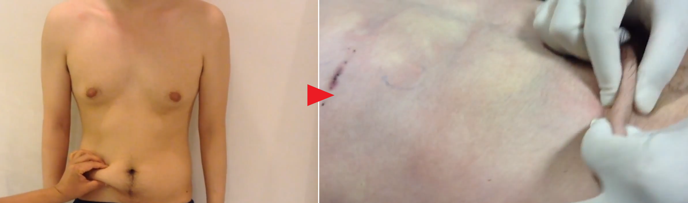 術前と脂肪吸引直後の脂肪量の比較