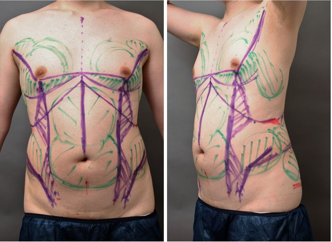 脂肪吸引(男性)の術前マーキング