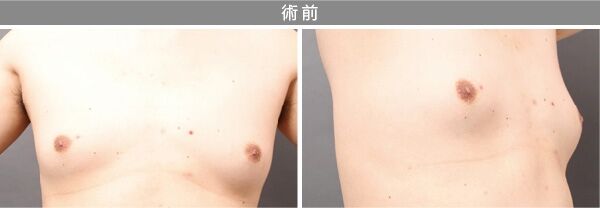 真性女性化乳房の術前画像