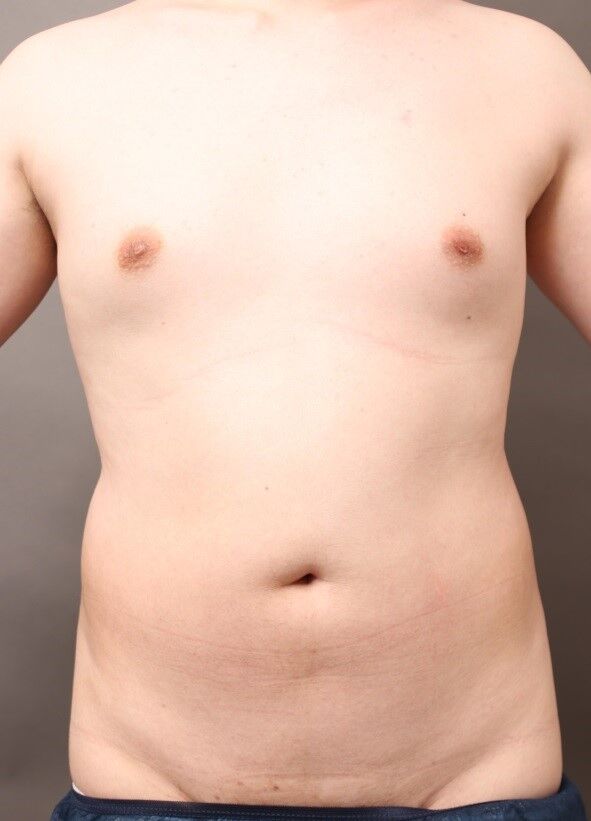男性のお腹の脂肪吸引(術前)