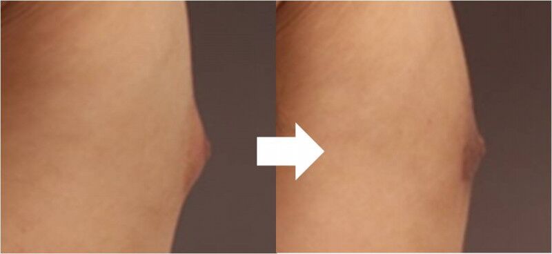 女性化乳房の乳輪の色味の変化