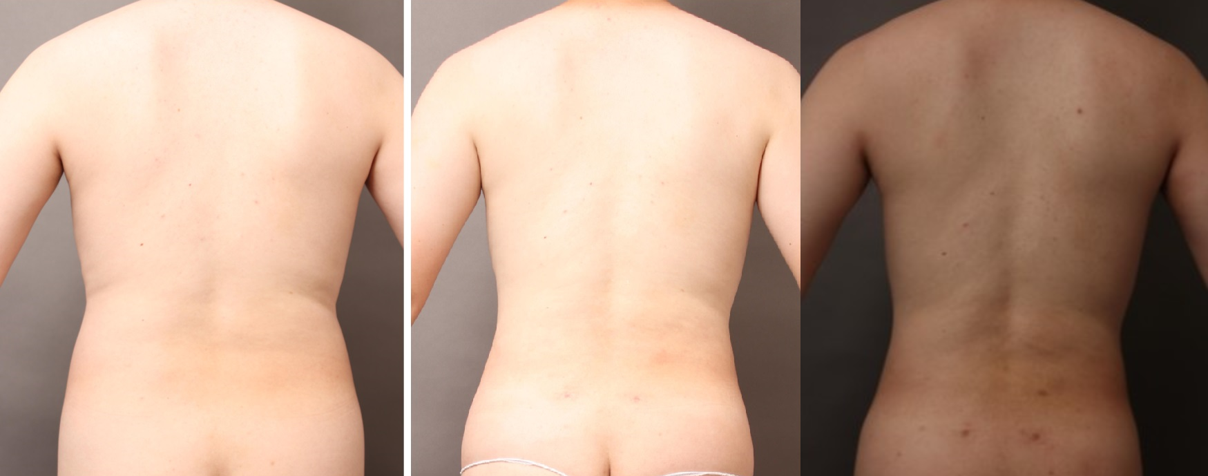 脂肪吸引の術前後比較(男性/背)