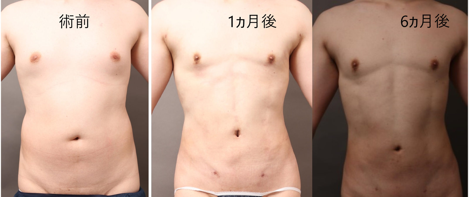 脂肪吸引の術前後比較(男性/正面)