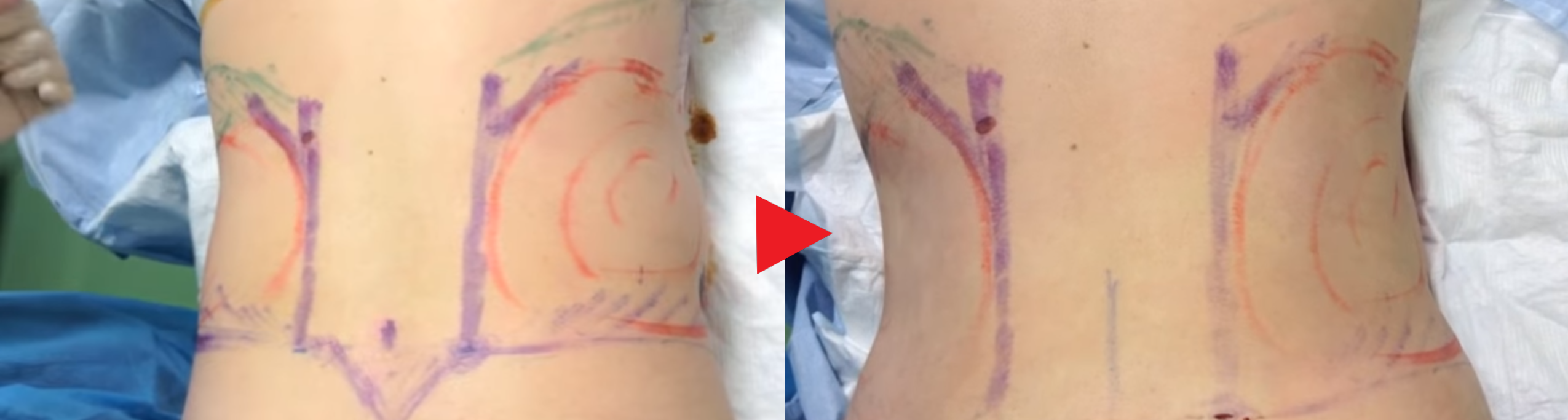 脂肪吸引直後(男性/背面)