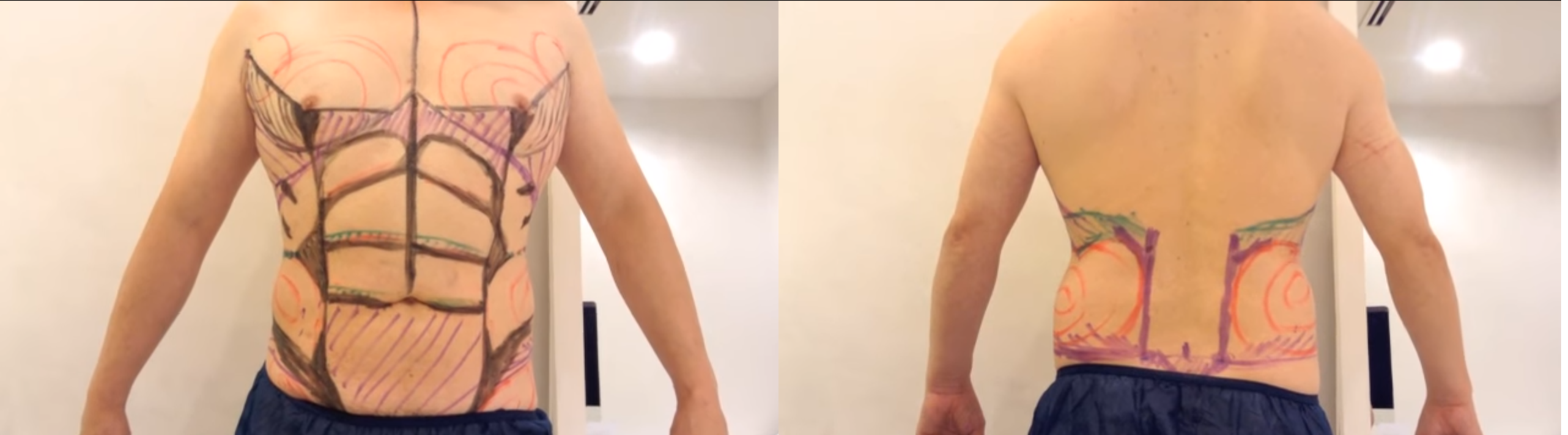 脂肪吸引前のマーキング(男性)