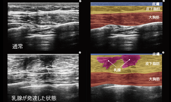 真性女性化乳房のエコー画像