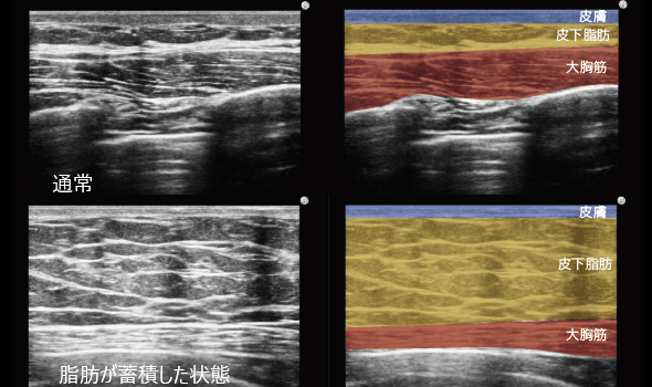 偽性女性化乳房のエコー画像
