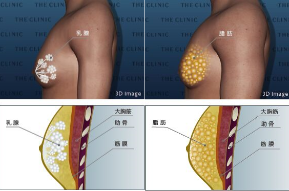 真性女性化乳房と、偽性女性化乳房の違い