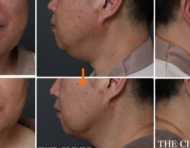 顔の脂肪吸引でここまで変わる! ～ある男性モニターの場合～